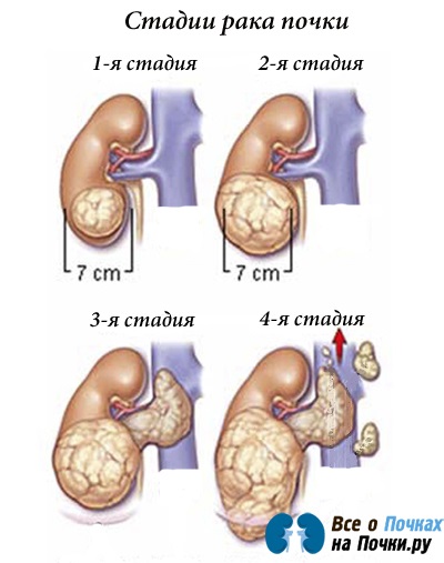 Cancerul de rinichi la bărbați și femei continuă viața