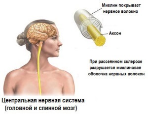 Scleroza multiplă - cauze, simptome și remedii folclorice pentru scleroza multiplă