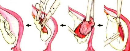 Chistul de retenție - simptome, cauze, tratament și diagnostic