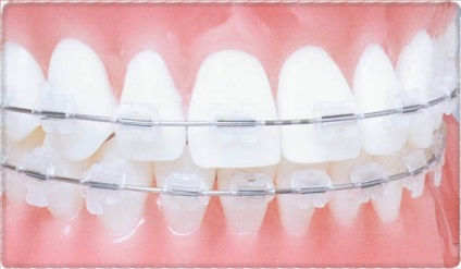 Ortodonție detașabilă