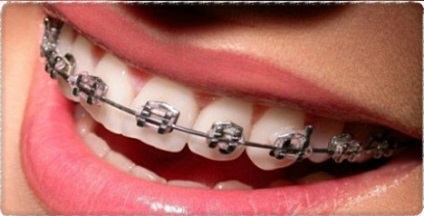Ortodonție detașabilă