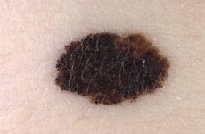 Simptomele și tratamentul melanomului ocular