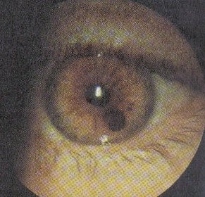 Simptomele și tratamentul melanomului ocular