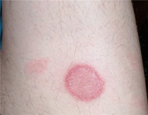 Simptomele venelor varicoase și o dietă pentru venele varicoase