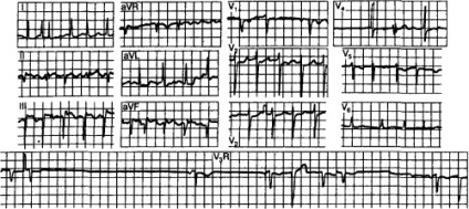 Sindicală bradicardie-tahicardie manifestarea electrocardiografică a disfuncției nodului sinusal