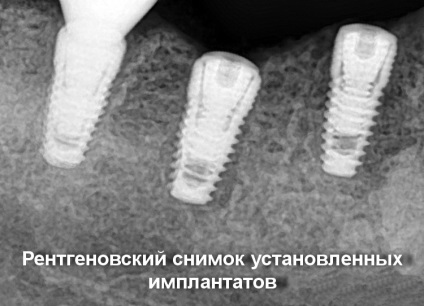 Renovarea estetică foarte modernă a dinților lipsă pe implanturi