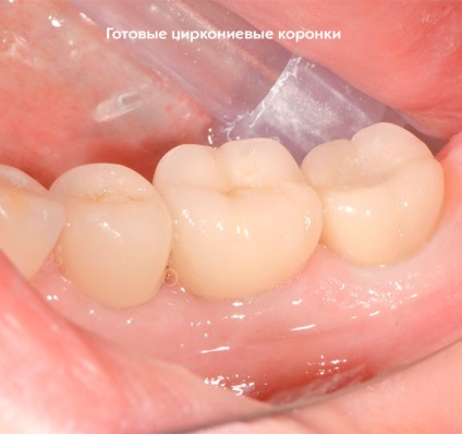 Renovarea estetică foarte modernă a dinților lipsă pe implanturi