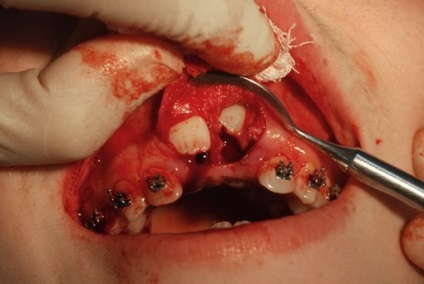 Eliminarea indicațiilor superioare ale dinților, metodele de anestezie și proces