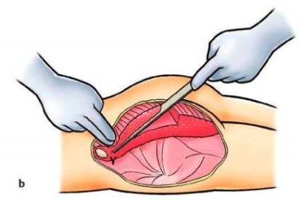 A combok mellnagyobbítás szilikon implantátumok Krasnodar - árak, áttekintésre, valódi fotók előtt és után,