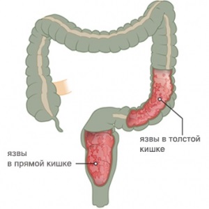 Tipuri de colită spastice, catarale, atonice, granulomatoase, erozive, membranoase