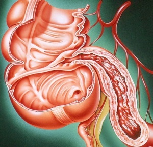 Tipuri de colită spastice, catarale, atonice, granulomatoase, erozive, membranoase