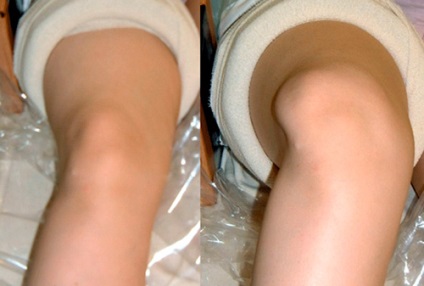 Dislocarea caliciului articulației genunchiului