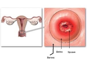 HPV și tratamentul eroziunii cervicale