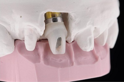 Temporar Abutment