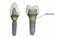 Temporar Abutment