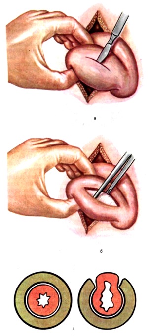 veleszületett pylorus stenosis