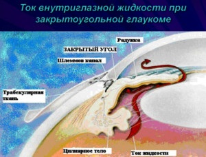 Glaucomul cu unghi închis - cauze, simptome și metode de tratament