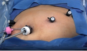 Acces abdominal cu laparoscopie, puncte de acces