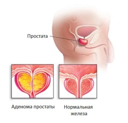 Adenomul proliferării glandelor prostate din jurul uretrei