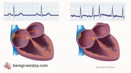 Aritmia cardiacă provoacă, simptome, tratament