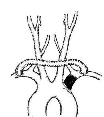 Reconstrucții arteriale