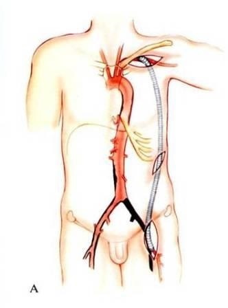 Reconstrucții arteriale