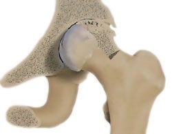 Arthrodesis de șold