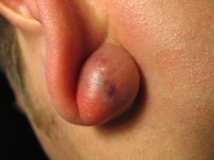 Atheroma în spatele urechii și urechilor inflamarea glandelor sebacee, tratament la domiciliu