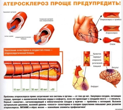 Ateroscleroza și cauzele hipertensiunii arteriale, tratamentul, prevenirea