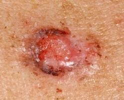 Basalom, cancer de piele, tipuri, tratament - site-ul 