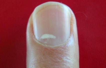 Pete albe pe unghiile degetelor cum se tratează