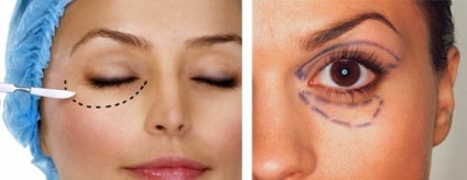 Blefaroplastia - o procedură cosmetică pe pleoape