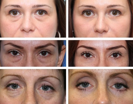 Blefaroplastia - o procedură cosmetică pe pleoape