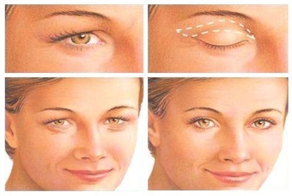 Blefaroplastia (plastica pleoapelor)