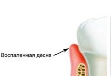 Guma este dureroasă asupra stomatologiei dentare anterioare (gingivită)