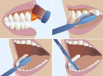 Guma este dureroasă asupra stomatologiei dentare anterioare (gingivită)