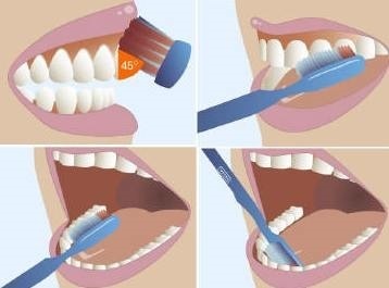 Fájó íny feletti első fogak (gingivitis) Fogorvosi