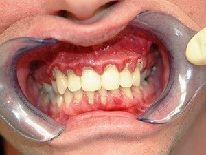 Guma este dureroasă asupra stomatologiei dentare anterioare (gingivită)