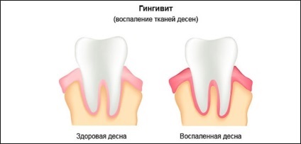 Венците над зъба при натискане защо това се случва