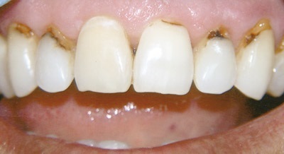Венците над зъба при натискане защо това се случва