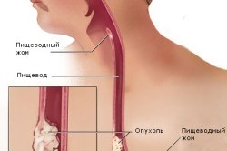 Durerea din esofag în timpul înghițitului