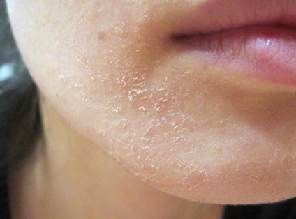 Mi a teendő, ha a bőr az arcon erősen kifejtve és pirul