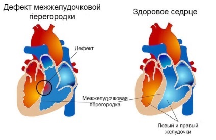 Defectul diagnosticului și tratamentului septului interventricular