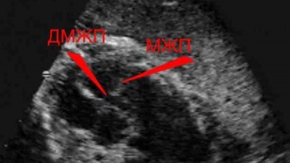 Defectul diagnosticului și tratamentului septului interventricular