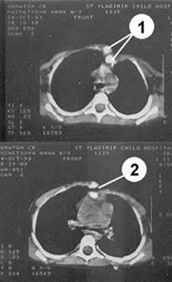 Deformarea toracelui după operația cardiacă