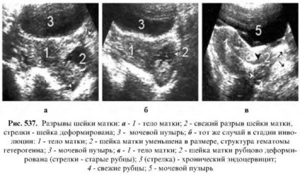 Diagnosticul bolilor uterului uterin