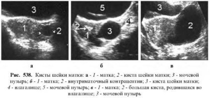 Diagnosticul bolilor uterului uterin