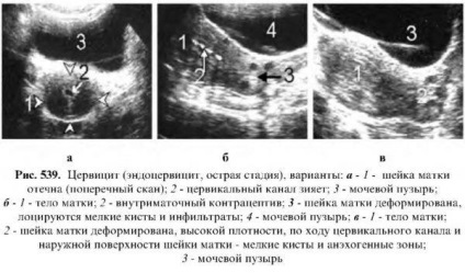 Diagnosticul bolilor uterului uterin