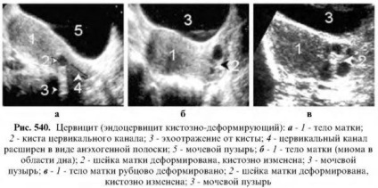 Diagnosticul bolilor uterului uterin