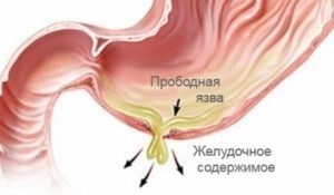 Dieta dupa o operatie ulcera perforata a ulcerului